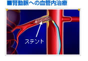 腎動脈への血管内治療