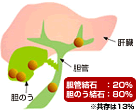 胆管結石と胆のう結石