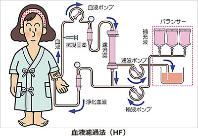 血液濾過法(HF)